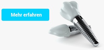 Implantologie Köln