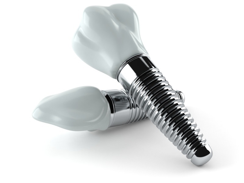 Implantologie Köln: Implantate von Zahnarzt Dr. Narouz